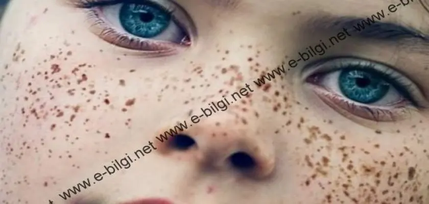 Çiller İçin Lazer Tedavisi Nasıl Uygulanır?