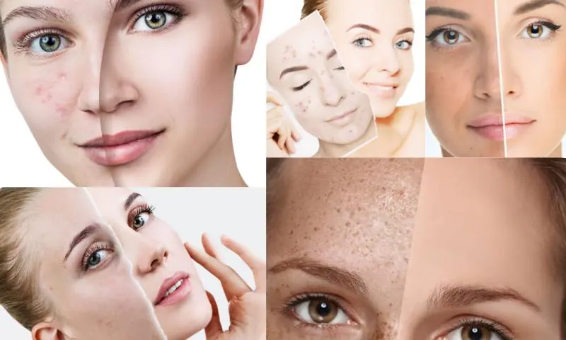 Leke Tedavileri Hakkında