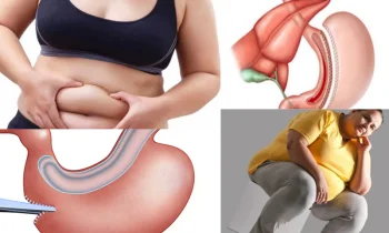 Mide Aldırma Ameliyatı Sonrası Beslenme Nasıl Olmalıdır?